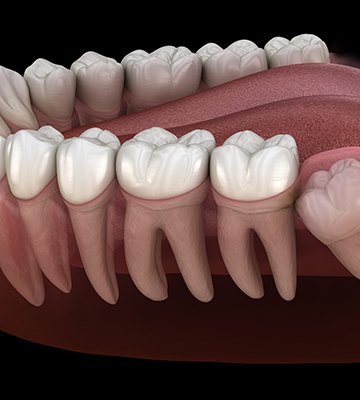 a 3D illustration showing impacted wisdom teeth