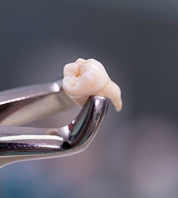 a close-up of a tooth being held by forceps