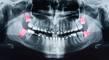 factors that can affect the cost of a wisdom tooth extraction include how many teeth need to be removed