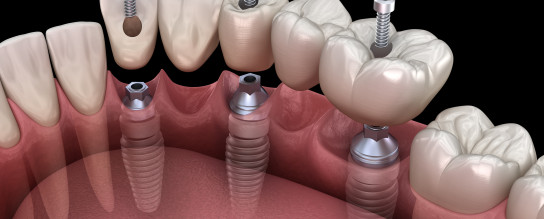 Zirconia bridge implant coupon