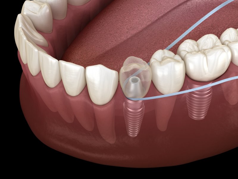 A 3D illustration of flossing with dental implants