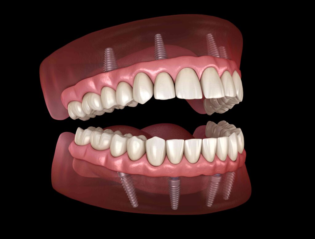 All-on-4 dental implants illustration